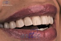 دندان های سفید چه تاثیری بر زندگی دارد؟