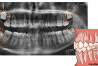 کشیدن دندان عقل؛ عوارض و مراقبت‌های بعد از آن و هزینه‌ ۱۴۰۲
